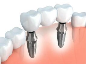 Highaland Dentist | dental implants | Highland Family Dentistry
