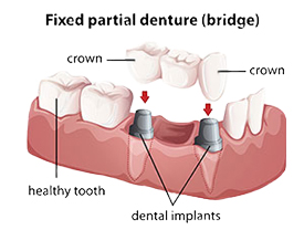 Highaland Preventive Dentist | dental bridges  | Highland Family Dentistry