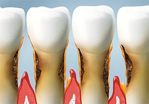 Highaland Preventive Dentist | gum disease treatment, bleeding gums | Highland Family Dentistry