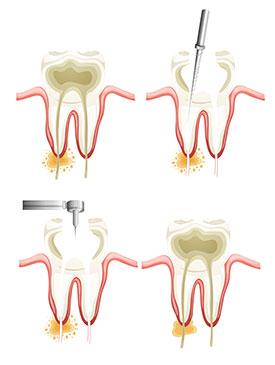 Highaland Preventive Dentist | root canals | Highland Family Dentistry